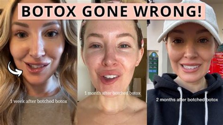 Botox Went Wrong: Understanding the Risks and Consequences