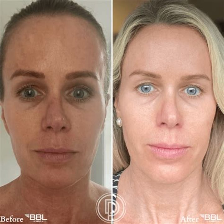 Does Ice Spice Have A BBL? Before And After Photos |
