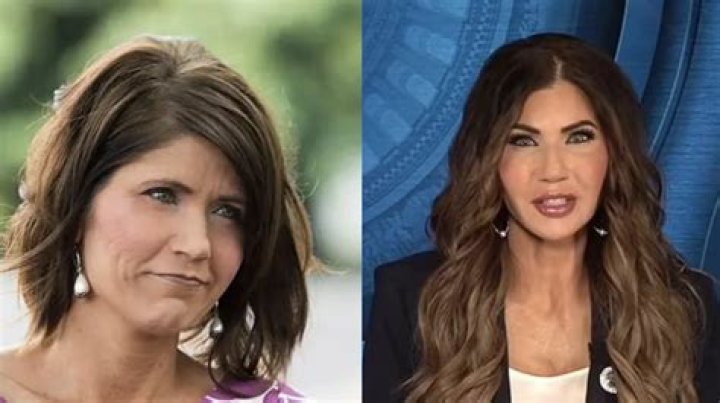 Kristi Noem Plastic Surgery Before After Pictures