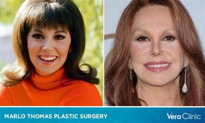Marlo Thomas's Plastic Surgery Journey: Unveiling The Transformation