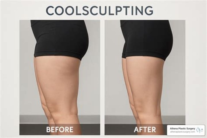 Results Gone Wrong: Cool Sculpting Before and After