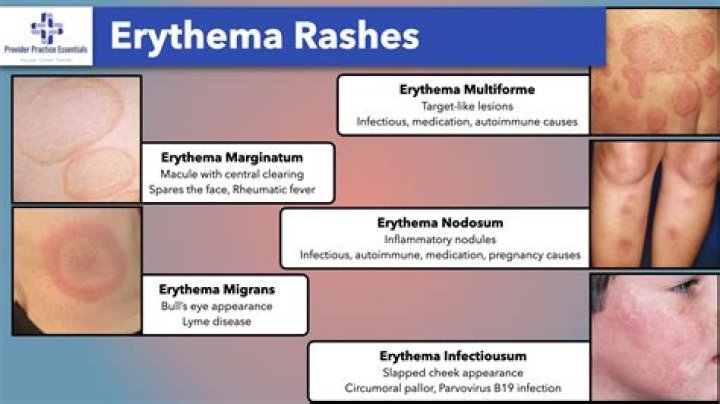 Unlock The Secrets Of Diffuse Mildly Erythematous Mucosa: Discoveries And Insights